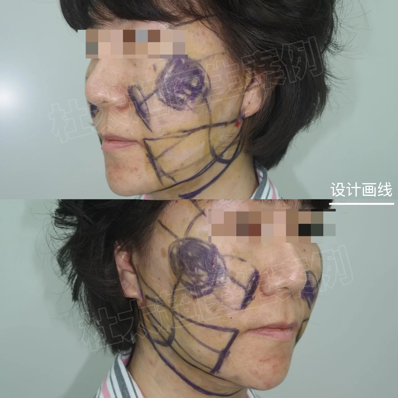 惊奇！拉皮手术还能告别“班味”？第二天却肿的像个馒头！！！