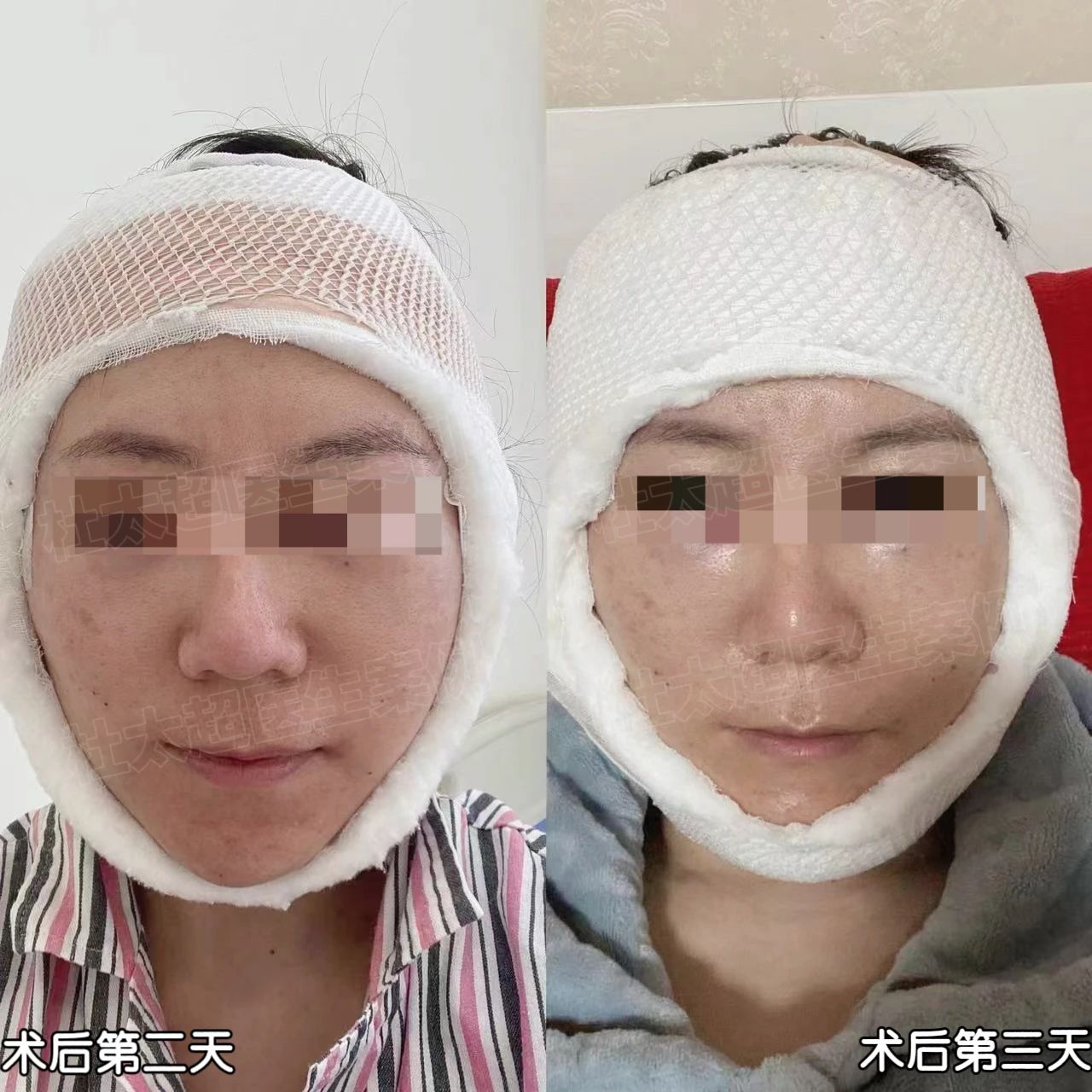 惊奇！拉皮手术还能告别“班味”？第二天却肿的像个馒头！！！