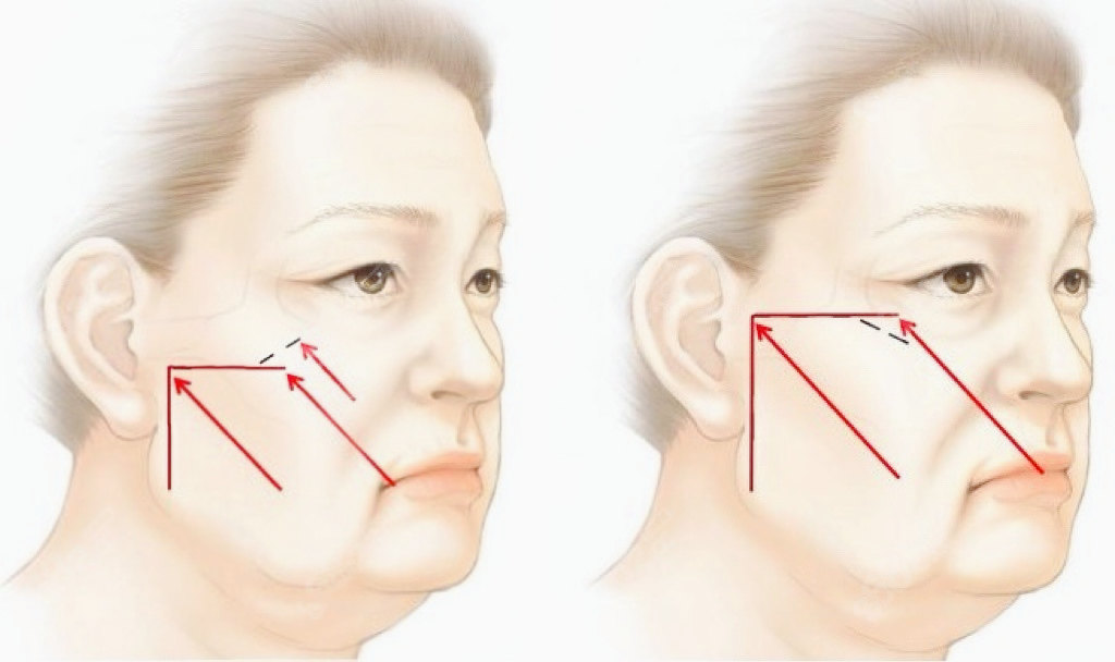 拉皮手术都会经历哪些“恐怖”的过程？整形外科专家深度解析