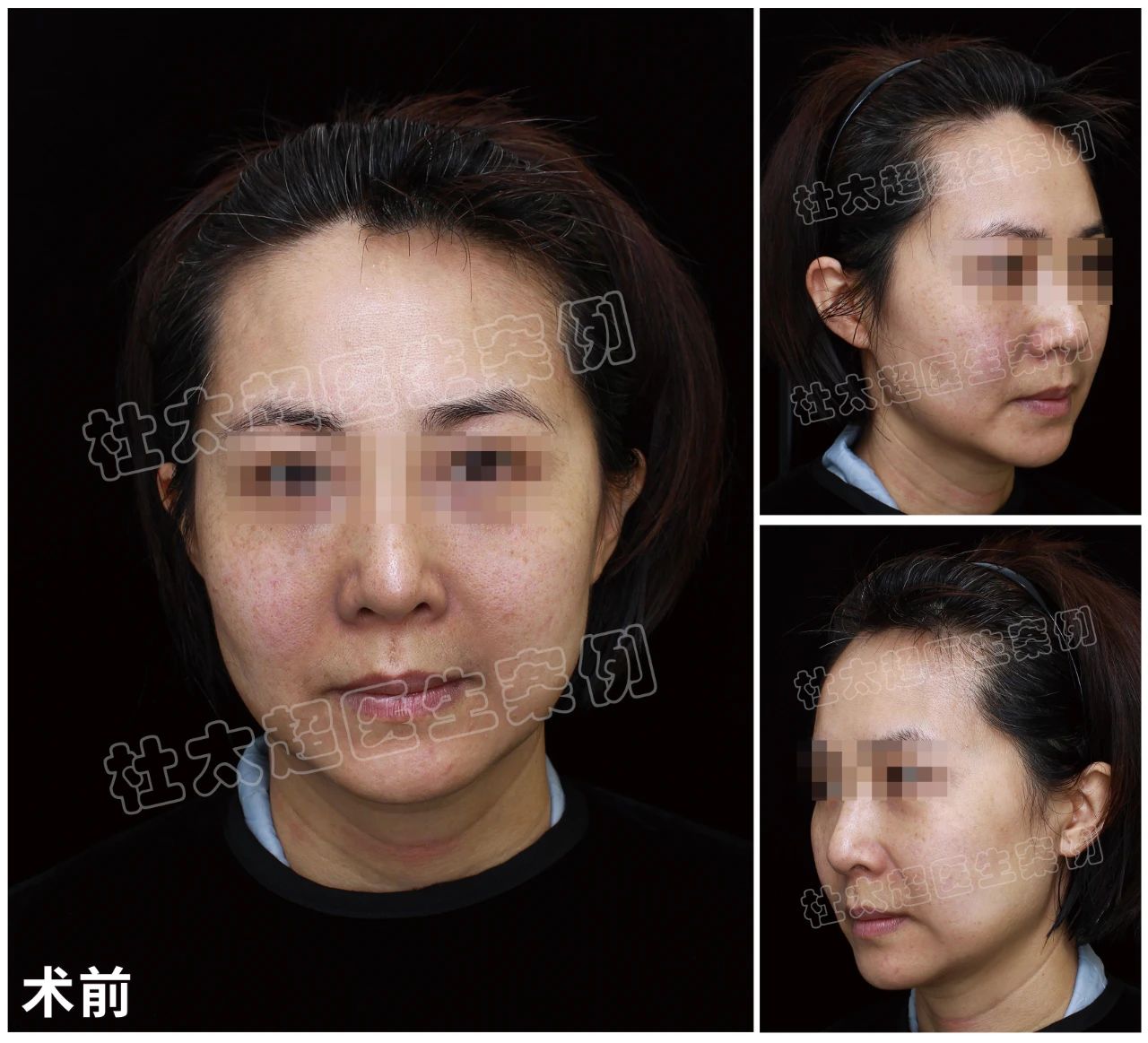 真没想到！我做完拉皮手术后，身边人居然集体抑郁了？是“惊艳”还是“惊吓”！