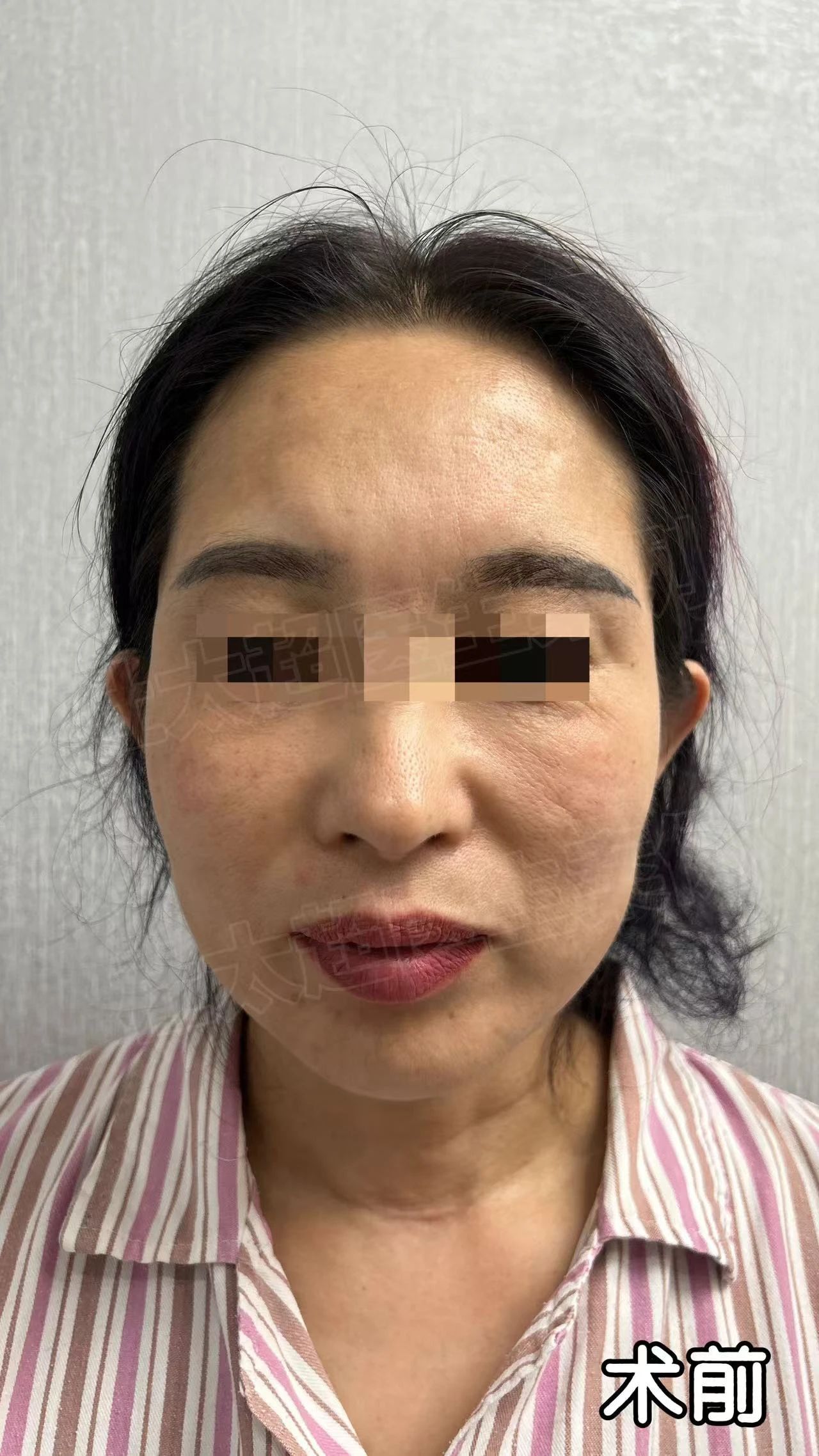 【曝光】我被5000元拉皮手术给毁了！是他拉我走出深渊！