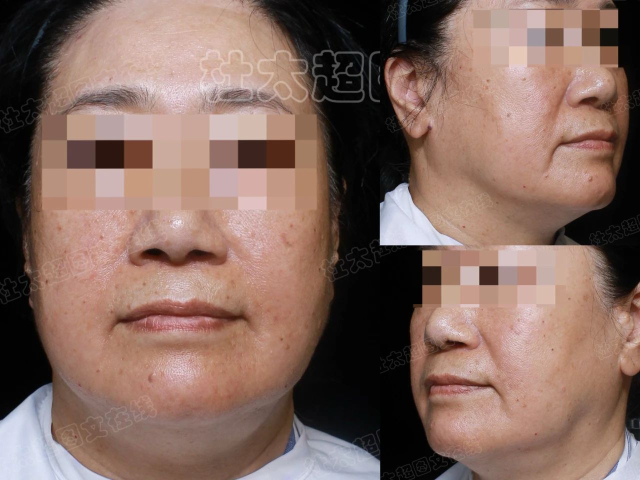 我为何执着于美容整形事业：拉皮手术背后的故事