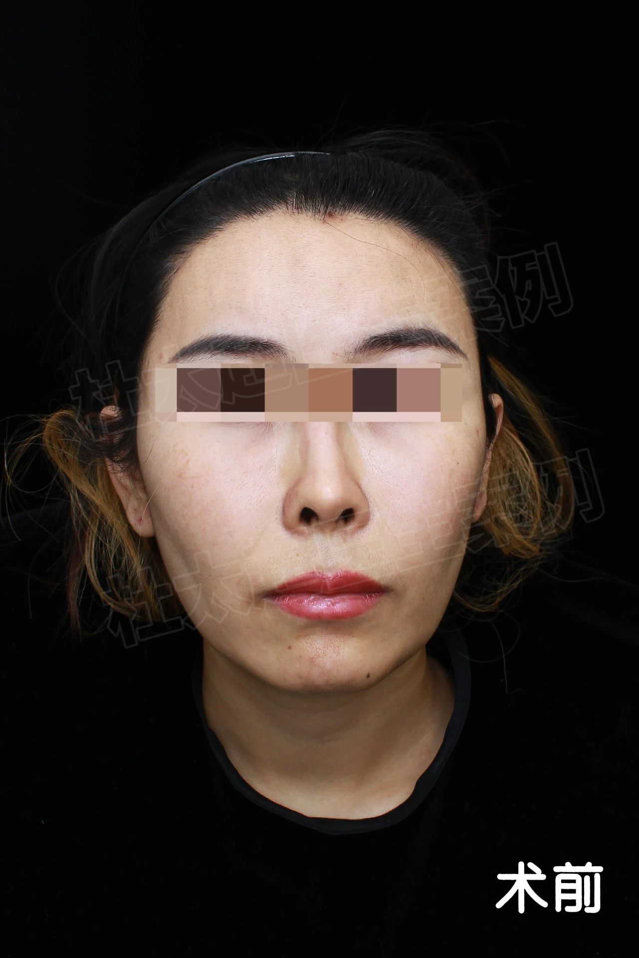 我做了明星同款拉皮！手术2个月后，我真的该为此崩溃吗？看看我现在的状态，你绝对会改变看法！