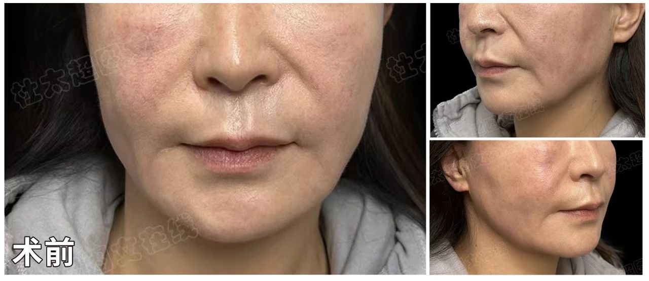 “烂脸”警示！4次线雕+1次面部吸脂的惨痛教训：第5次拉皮手术能否终结我的整形噩梦？