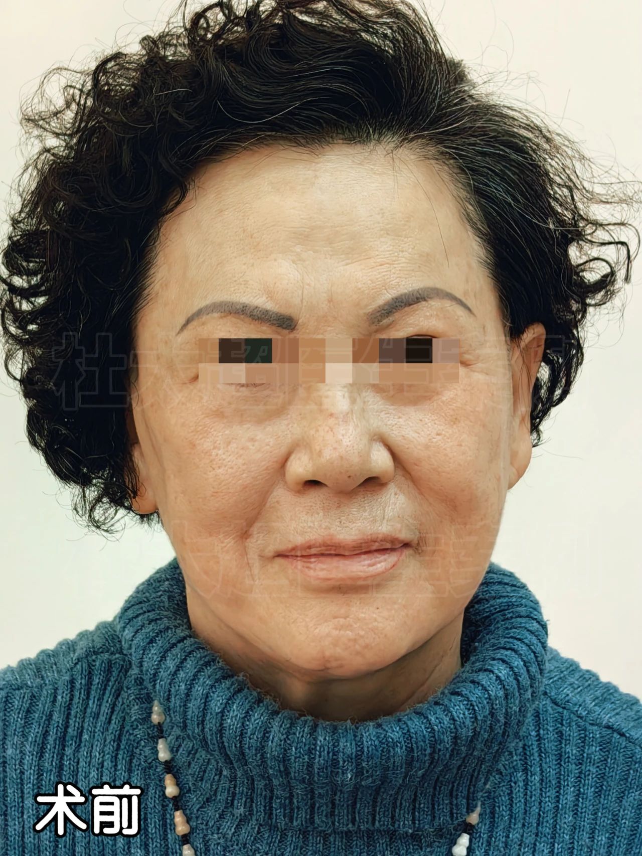 笑skr人！70多岁奶奶还敢尝试拉皮手术，这勇气简直了！