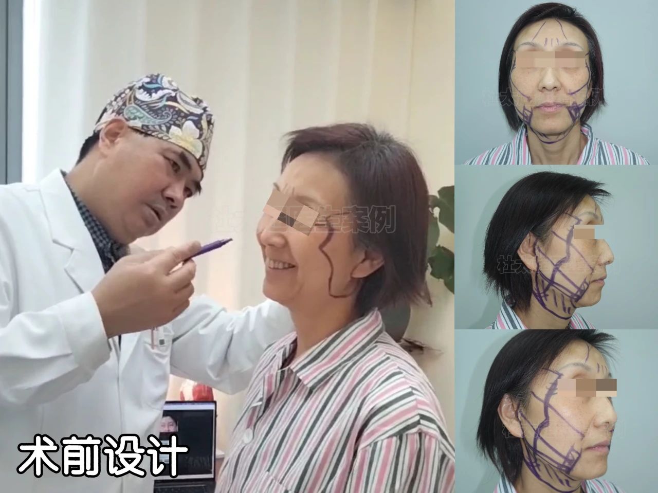 避免大“翻车！拉皮手术怎么做才能安全又有效？