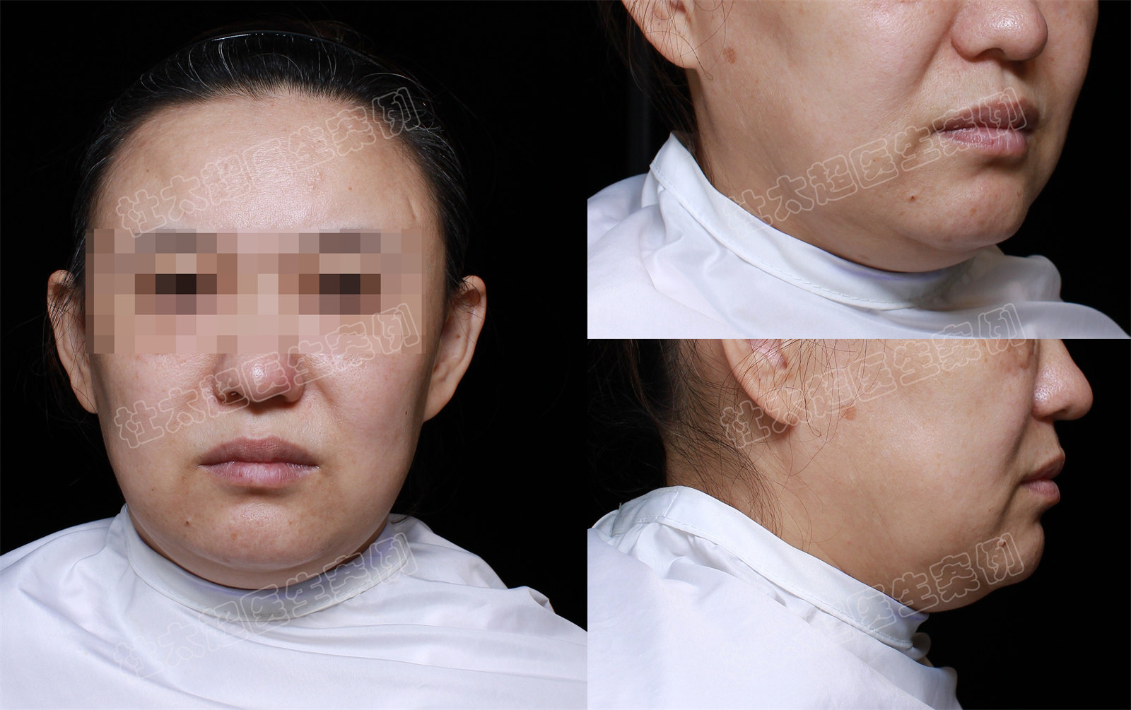 勇敢的人先享受美丽，看看她拉皮术后1个月的惊人变化