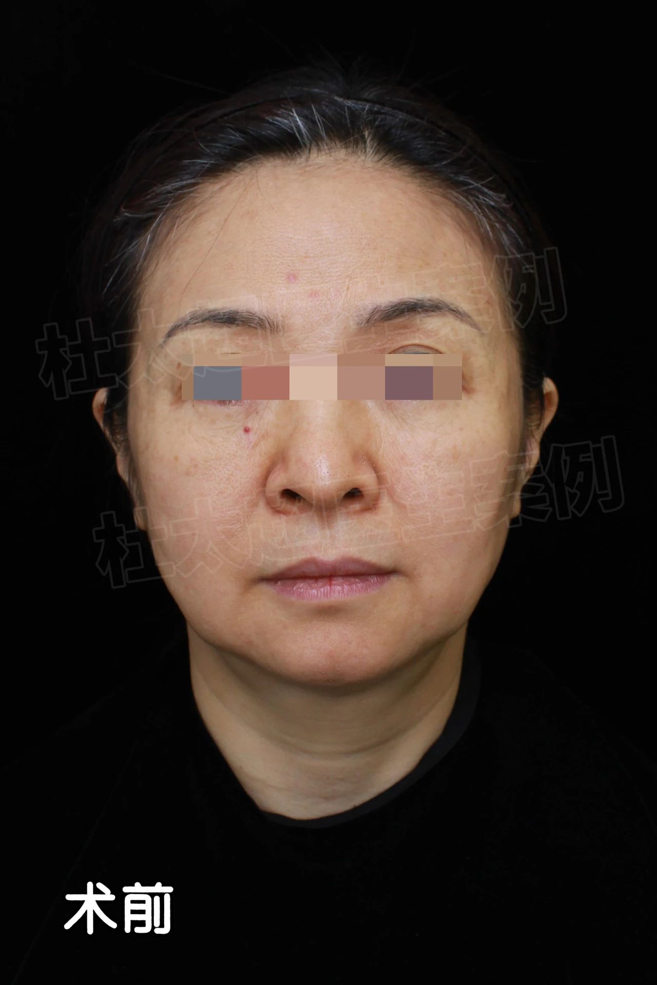 她们笑我越老越“妖”！我50岁做了拉皮手术，老公更爱了，她们都嫉妒了！