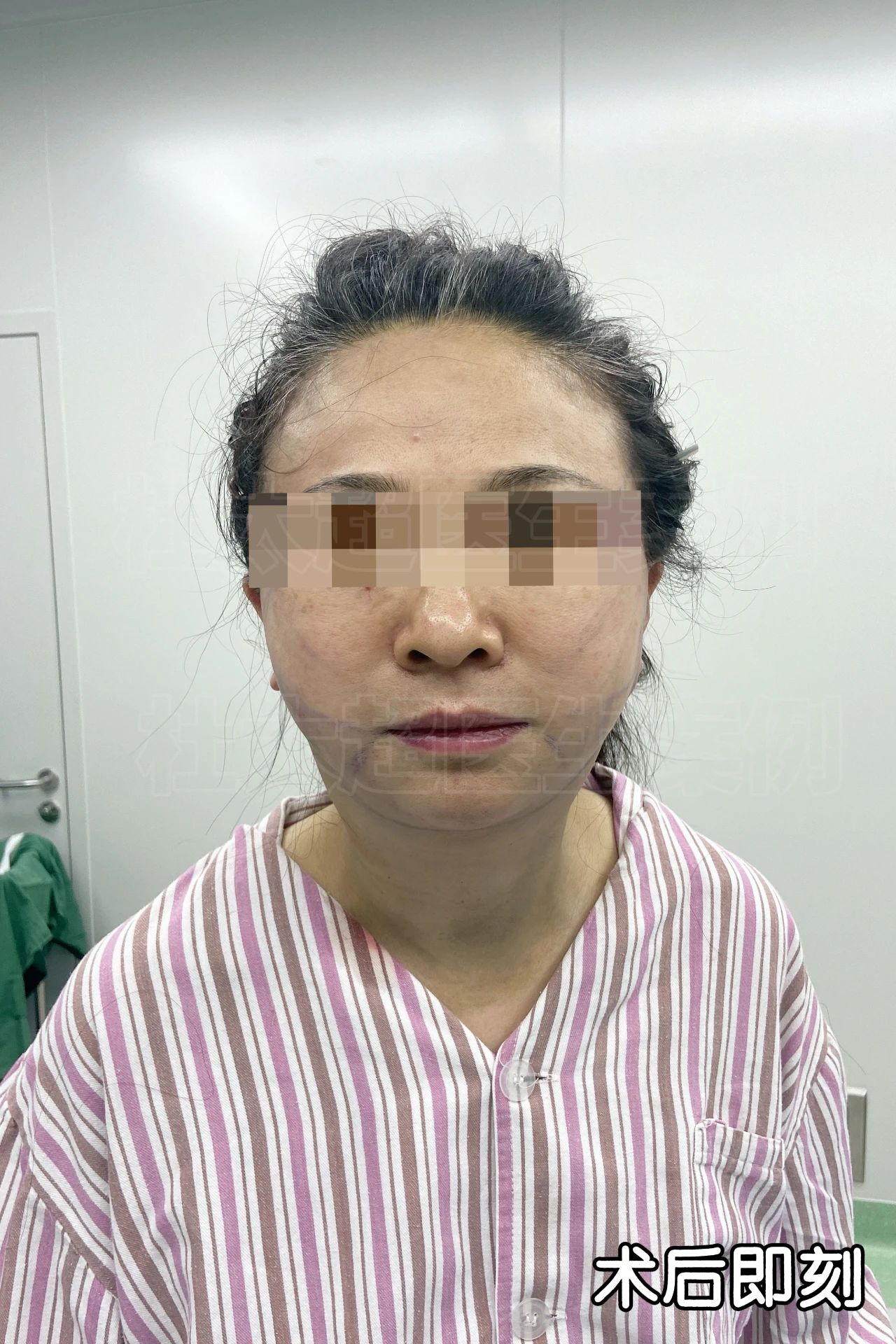 她们笑我越老越“妖”！我50岁做了拉皮手术，老公更爱了，她们都嫉妒了！