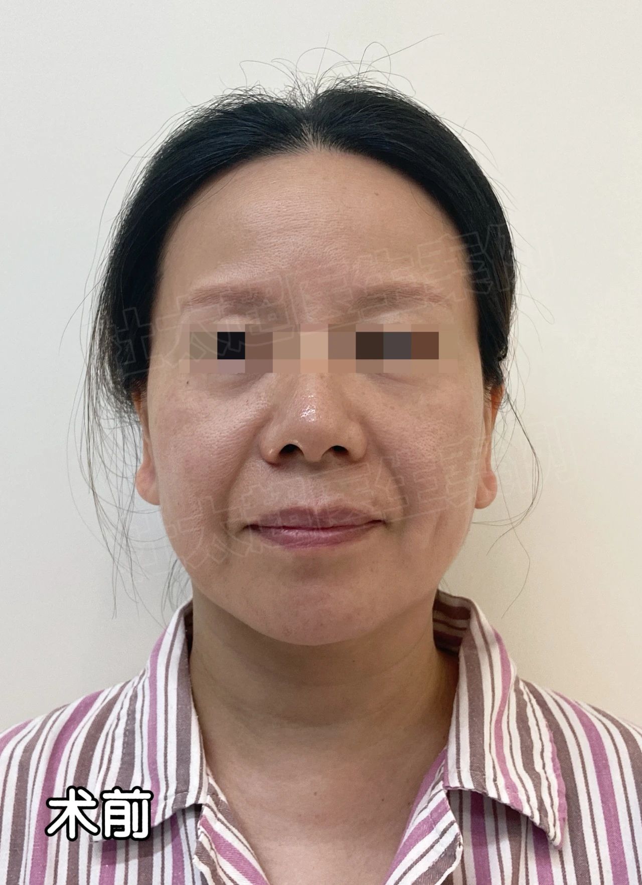 这样的效果你说差？49岁大姐携手47岁小妹一起做拉皮手术，术后效果让人不敢相信！