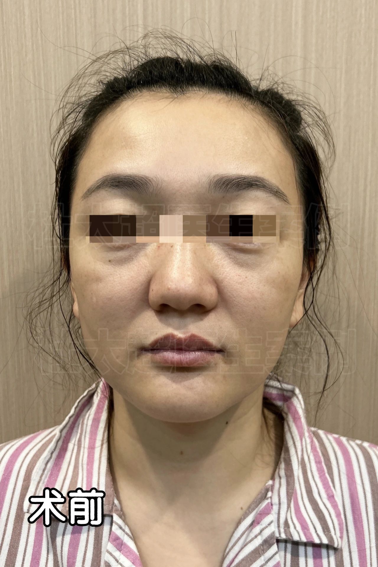 坑！只想做眼袋手术，结果到全脸9项的改造：我的意外“升级”花了多少钱？