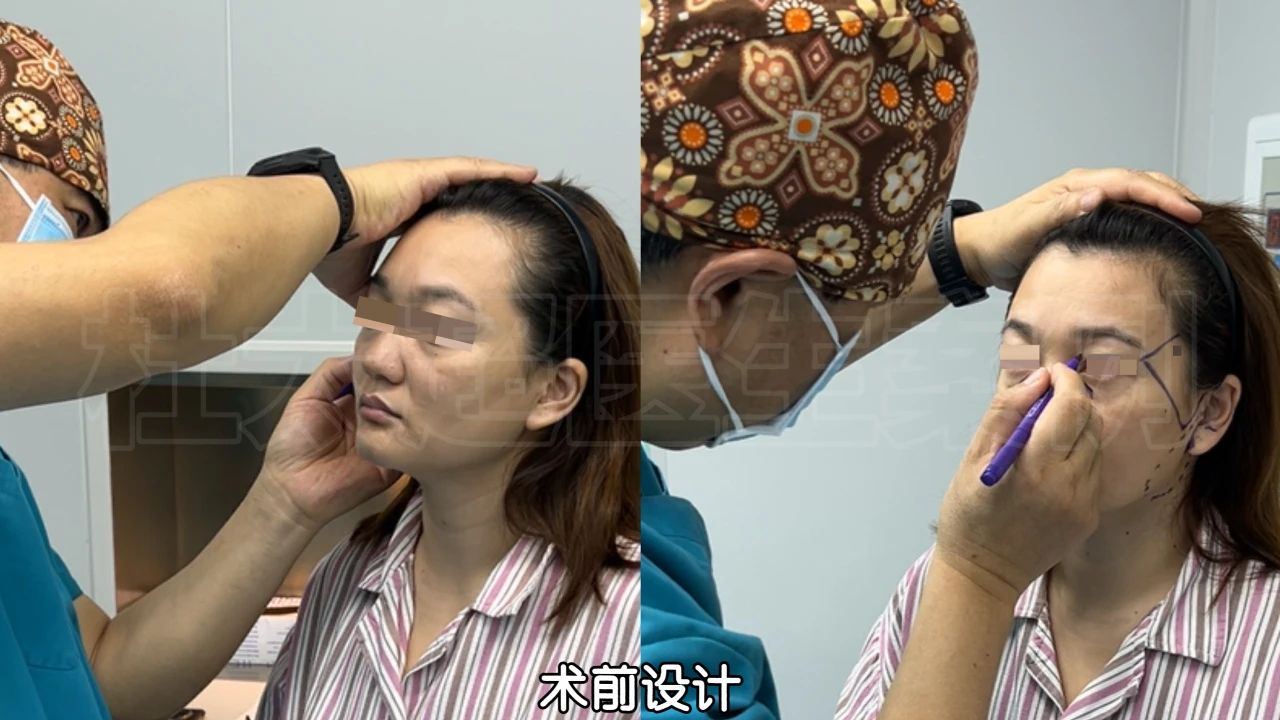坑！只想做眼袋手术，结果到全脸9项的改造：我的意外“升级”花了多少钱？