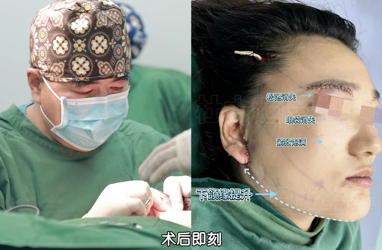 坑！只想做眼袋手术，结果到全脸9项的改造：我的意外“升级”花了多少钱？