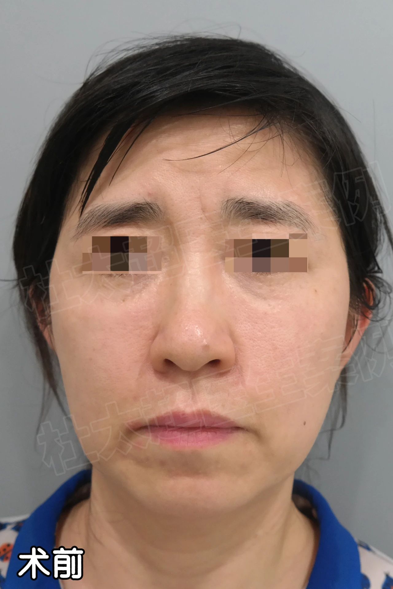 42岁，抑郁的我从低谷里爬了出来！拉皮手术，值得一试的美丽投资！