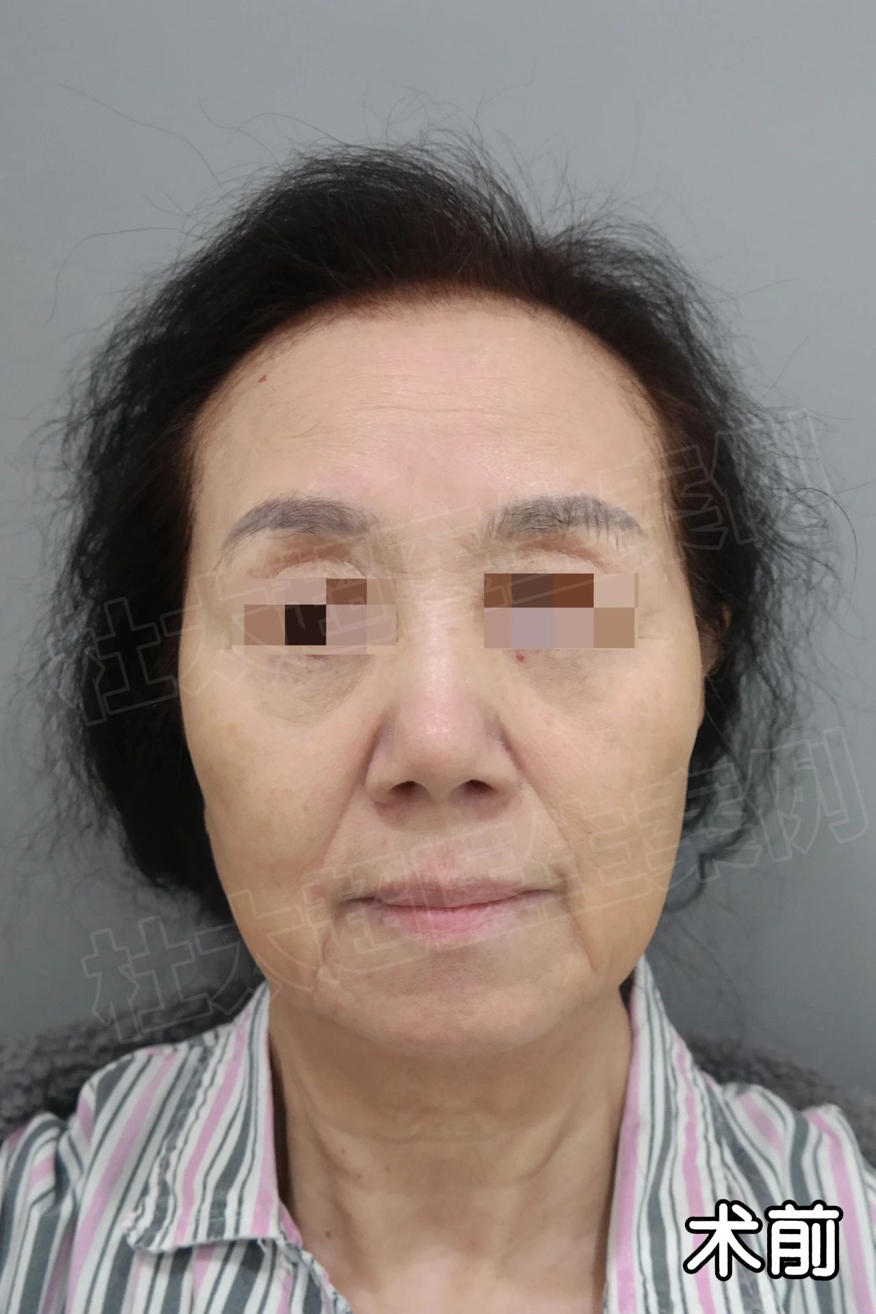 70岁奶奶“瞎折腾”！拉皮手术后说：3小时拉皮手术让我找回了初恋的感觉！