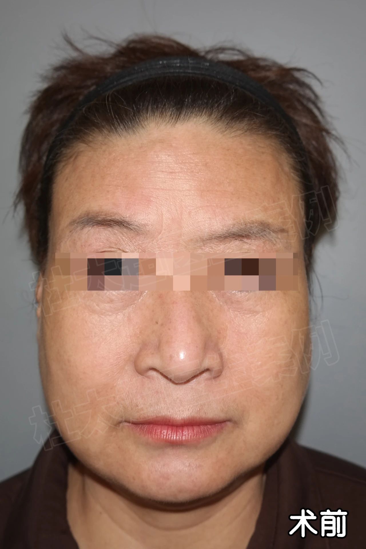 “这张老脸我是不要了”！53岁“老少女”的拉皮手术，上演一出反转好戏！