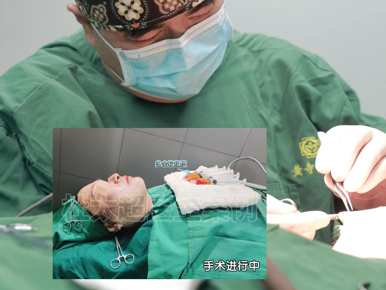 “这张老脸我是不要了”！53岁“老少女”的拉皮手术，上演一出反转好戏！