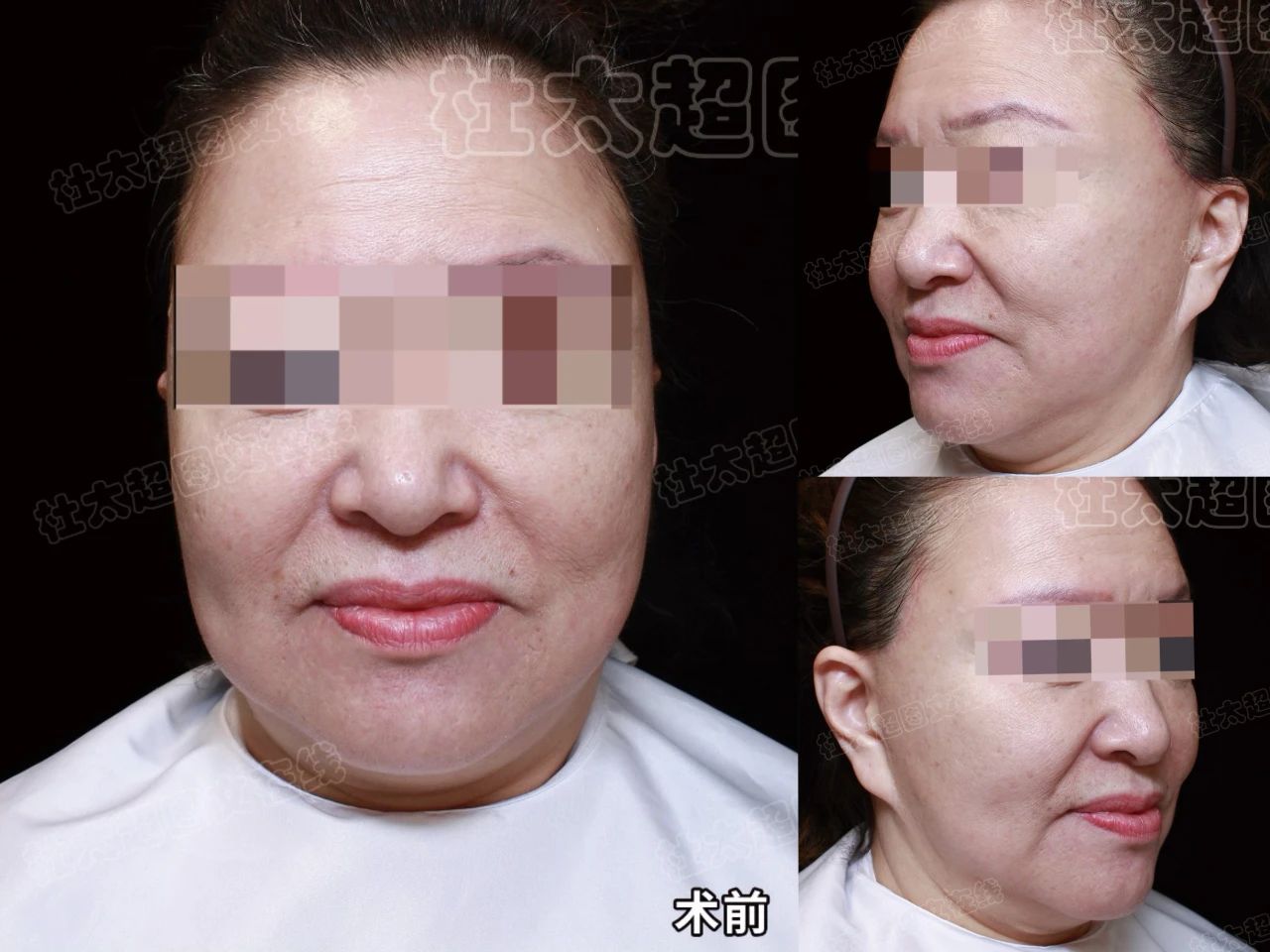 不原谅！失败2次，拉皮3次，10天抗争，我究竟得到了什么？