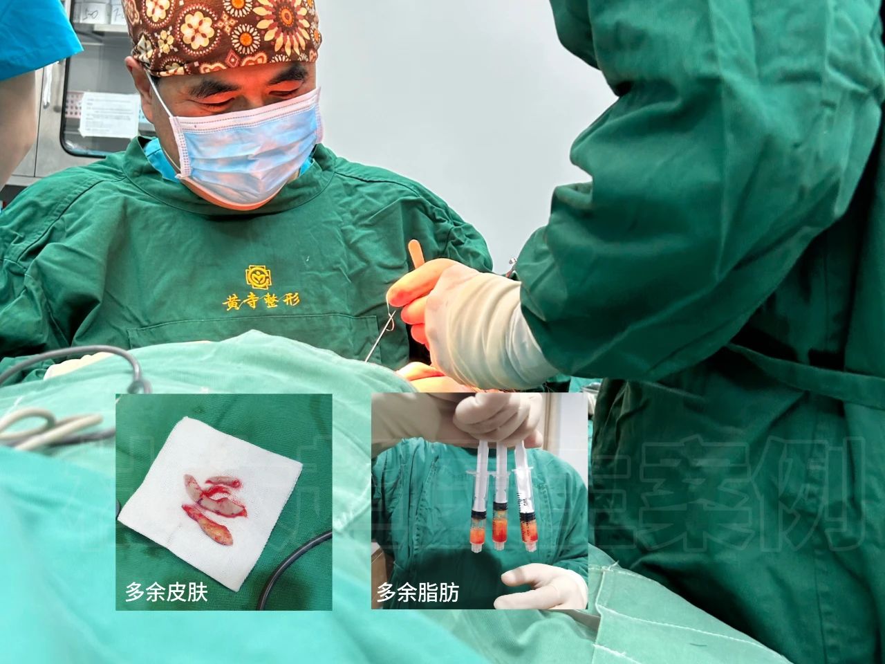 拉皮手术20天后把妈吓坏了！42岁女儿一意孤行，真相令人深思！