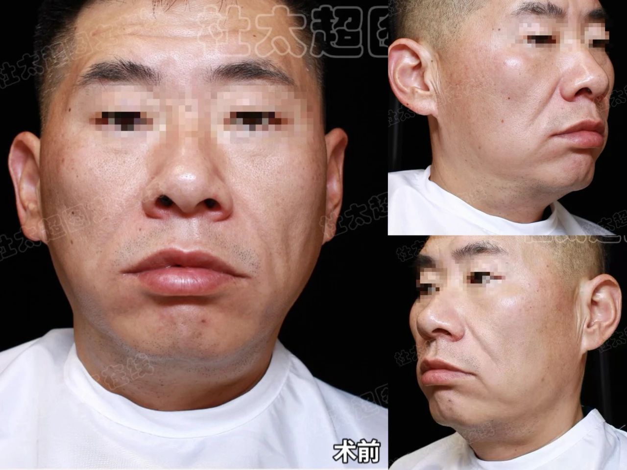 男人也爱面子？43岁从“不自信”到“自信爆棚”，只用了1次手术？揭秘拉皮手术背后秘密动机！