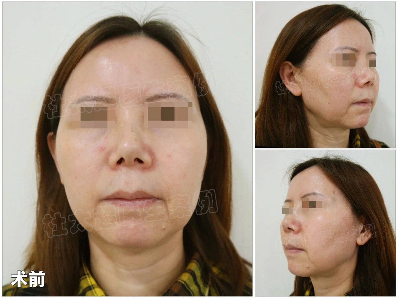 【揭秘】我亲手掀开“拉皮手术”12个不为人知的细节，99%的人我都不告诉他！