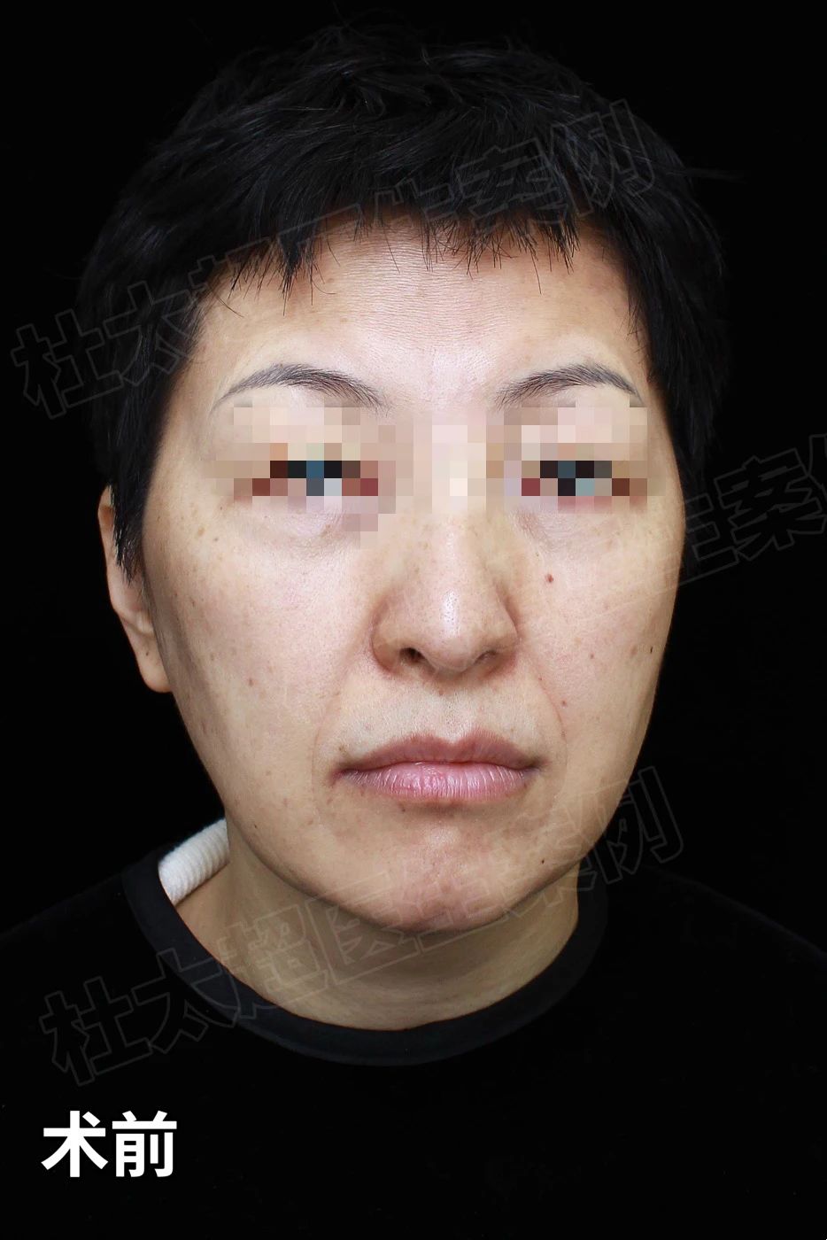 7天告别“孤寡相”，拉皮手术：仅需3小时，轻松解决！