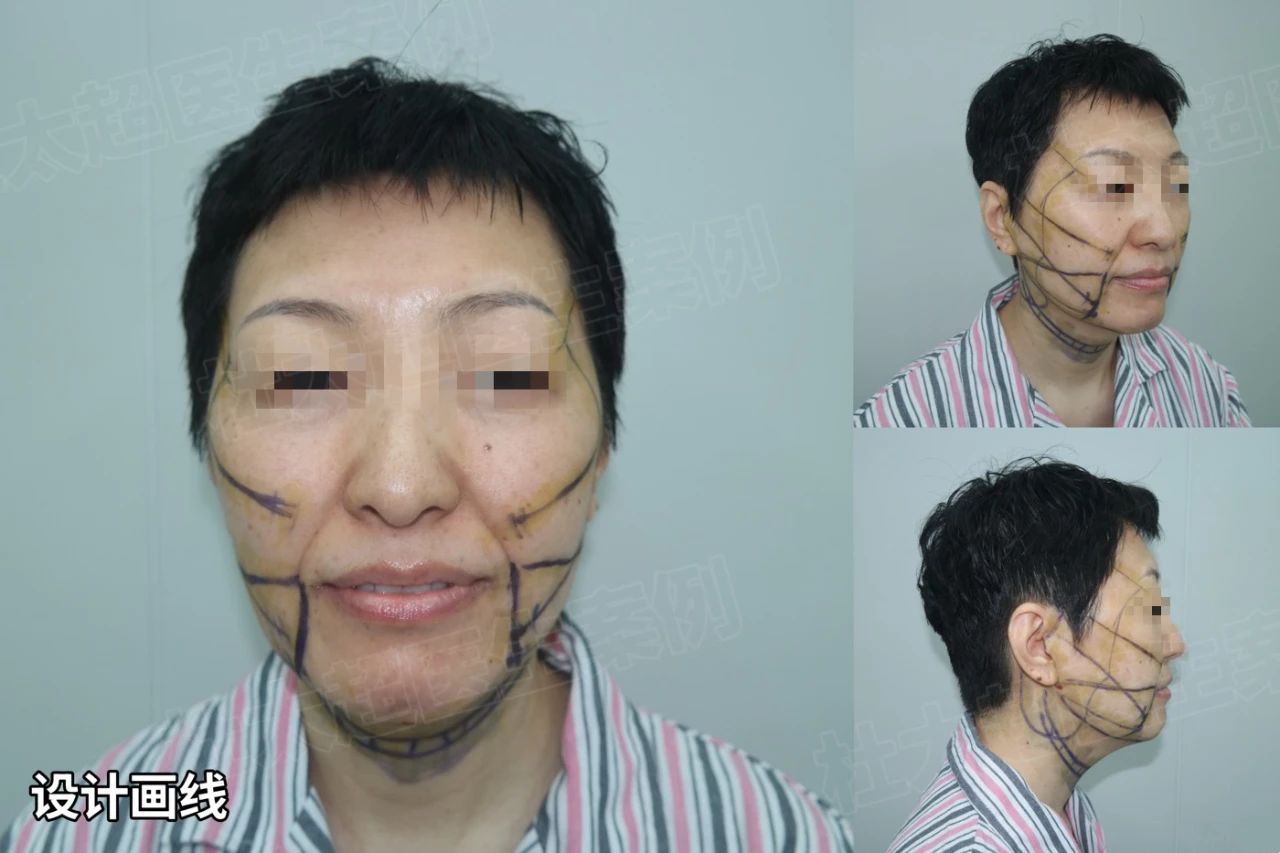 7天告别“孤寡相”，拉皮手术：仅需3小时，轻松解决！