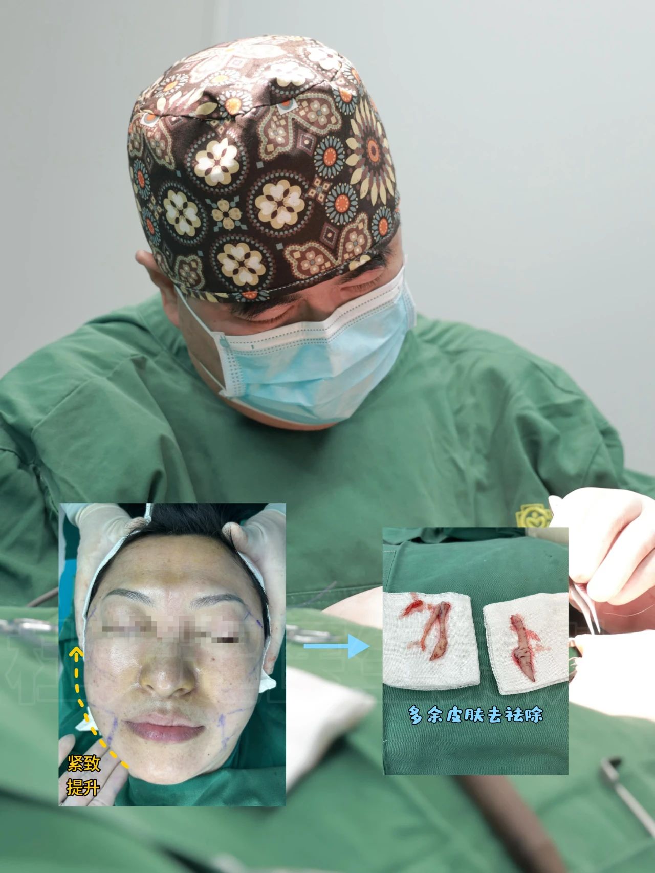 7天告别“孤寡相”，拉皮手术：仅需3小时，轻松解决！