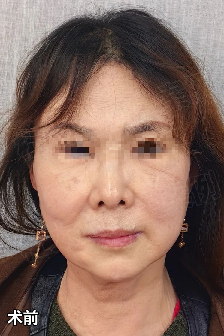 68岁拒绝被叫奶奶，实测3小时拉皮手术的逆龄回春!7个月后自称"小姑娘"...